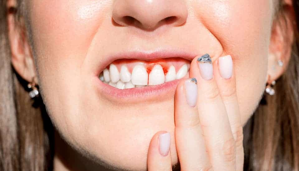 Close up of female mouth with gum disease