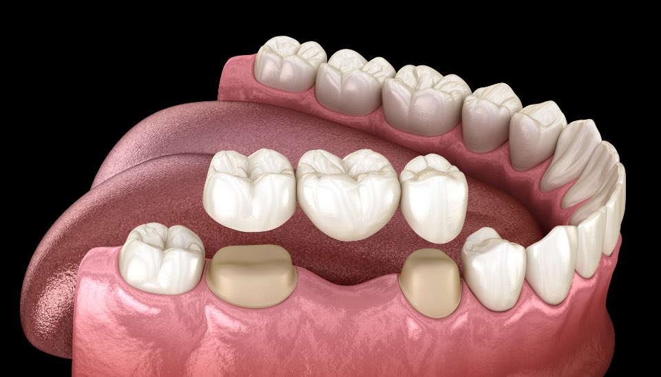 A diagram showing how dental crowns are fitted