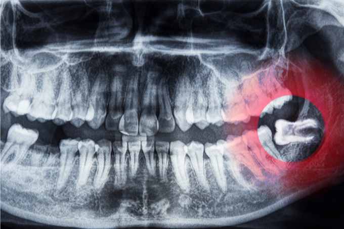 X-Ray of an impacted wisdom tooth