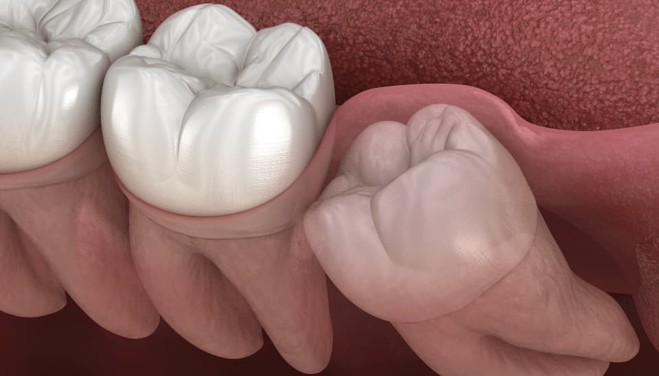 Image showing an impacted wisdom tooth