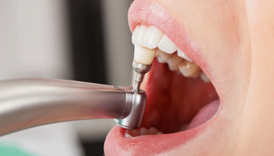 Professional teeth cleaning on a patient's mouth