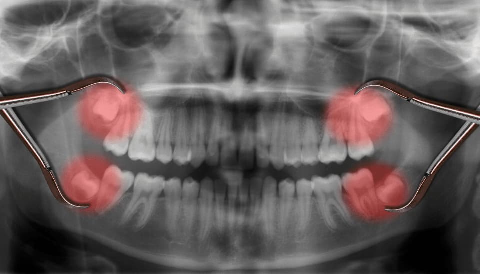 X-Ray showing location of wisdom teeth in mouth
