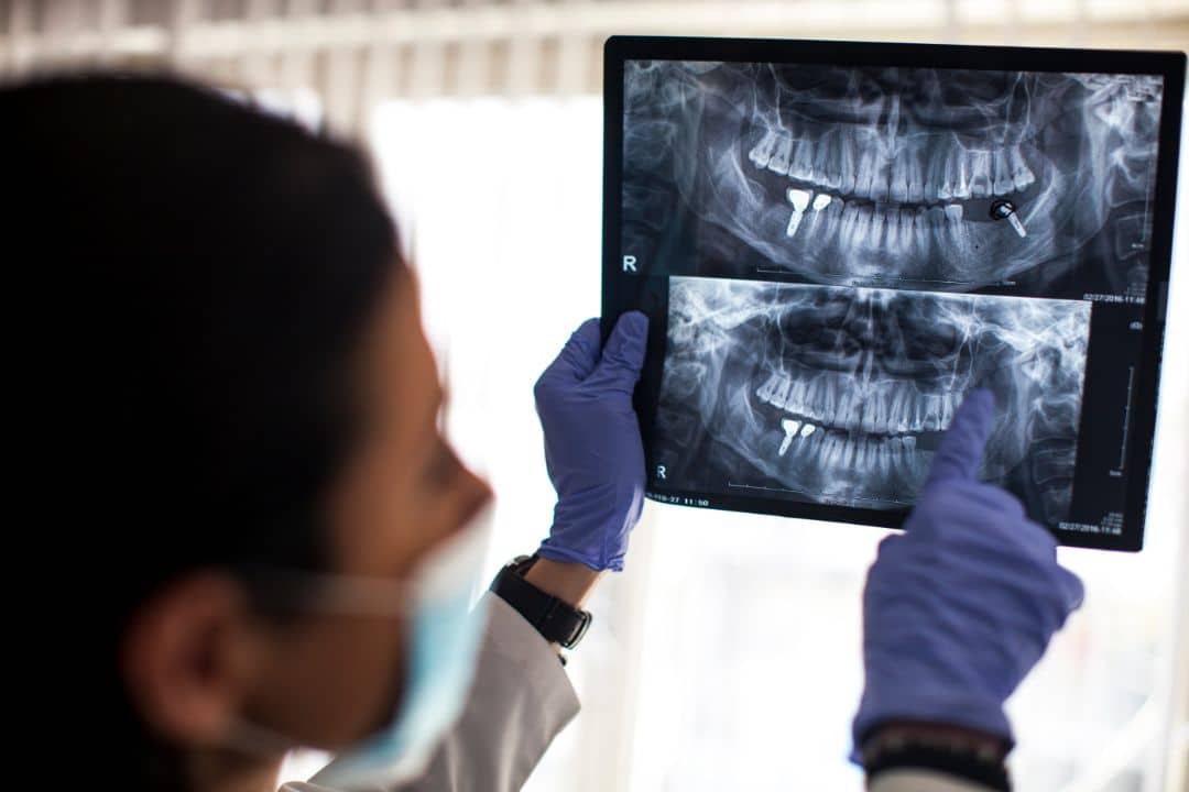 X-ray of a dental implant