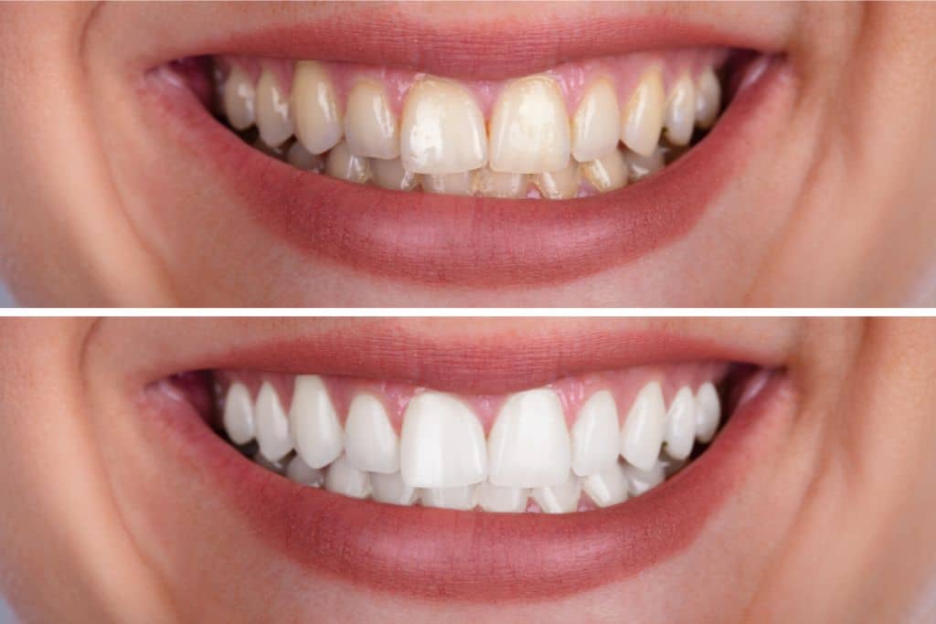 Side by side images before and after teeth whitening