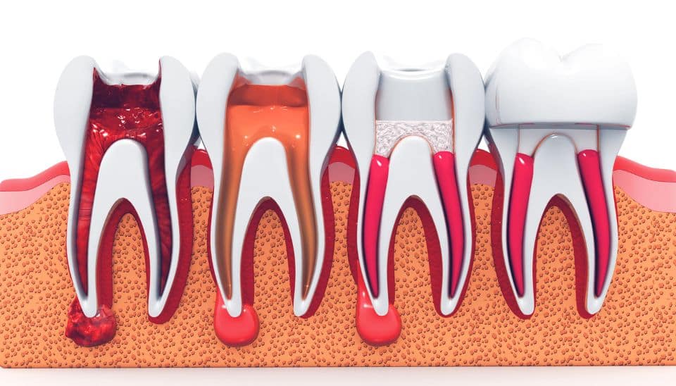 Stages of root canal treatment