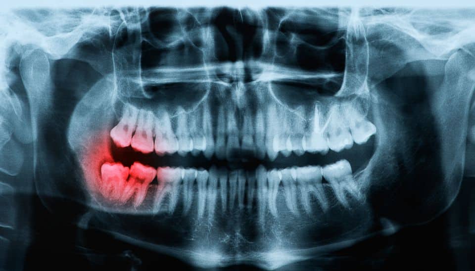 X-ray of wisdom teeth