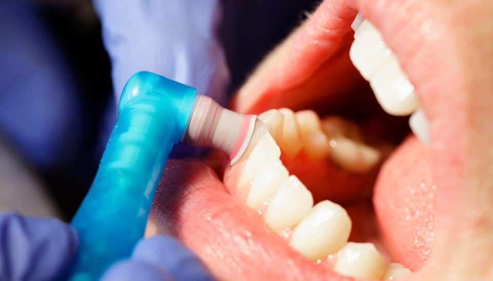 Professional Dental Cleaning
