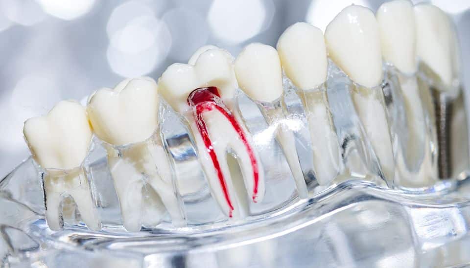 Root Canal Treatment