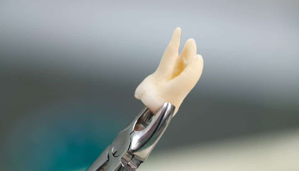 Tooth Extraction