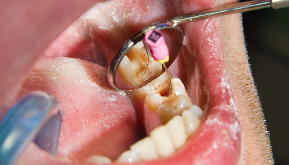 Cleaning of root canal