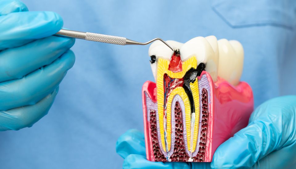 Root Canal Treatment Model