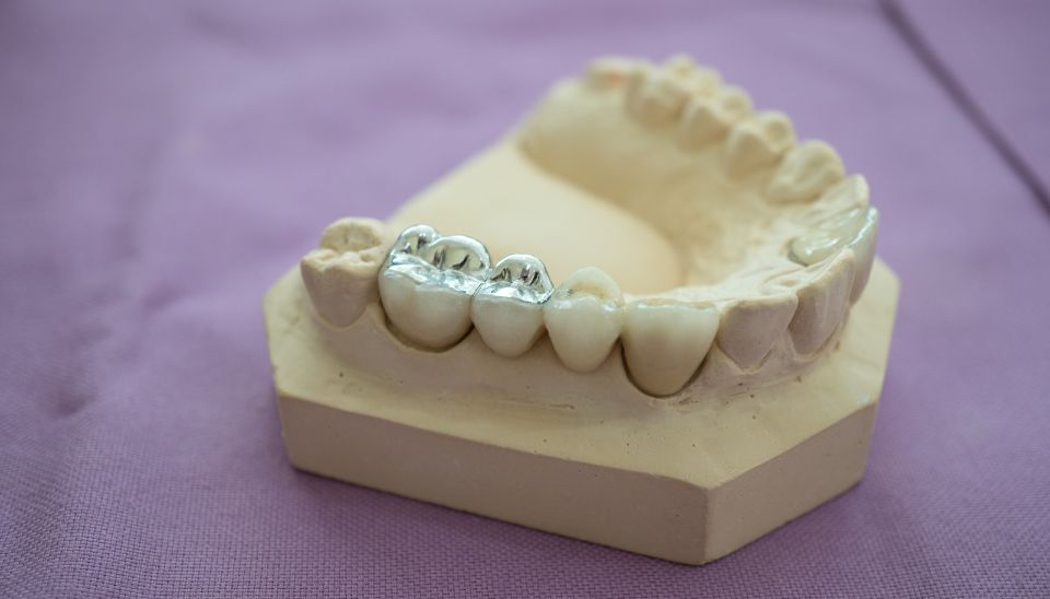 Amalgam filling example
