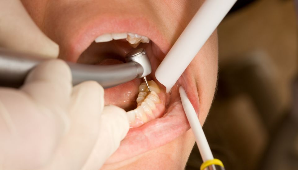 Dentist Drilling a Cavity in preparation for a filling